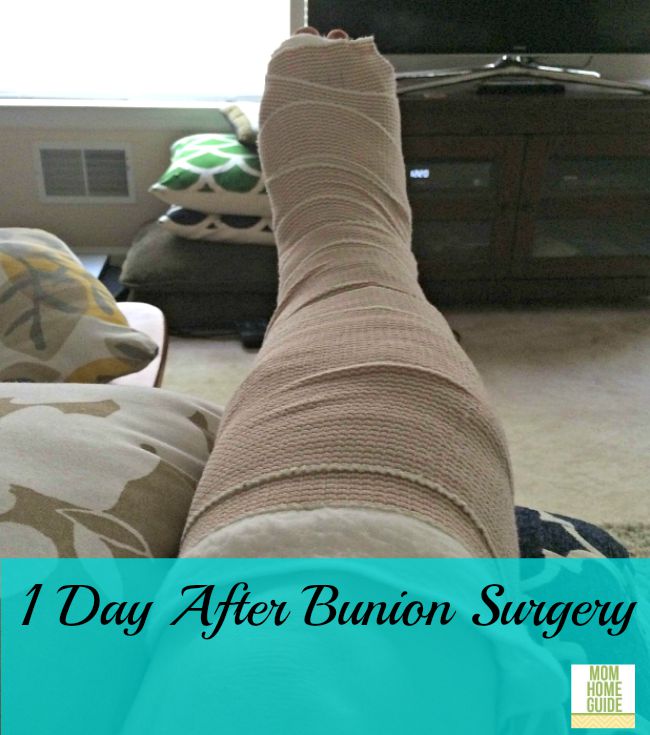 Foot one day after bunion surgery