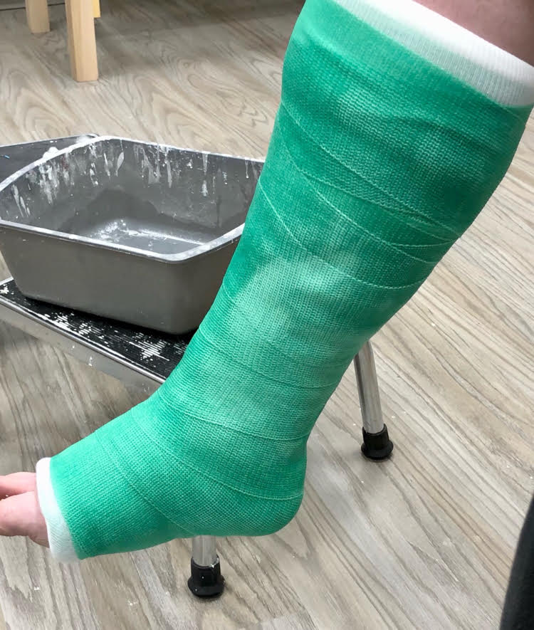 broken ankle cast colors